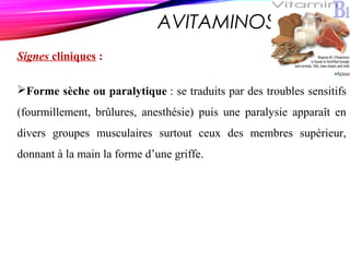 AVITAMINOSE B 1
Signes cliniques :
Forme sèche ou paralytique : se traduits par des troubles sensitifs
(fourmillement, brûlures, anesthésie) puis une paralysie apparaît en
divers groupes musculaires surtout ceux des membres supérieur,
donnant à la main la forme d’une griffe.
 