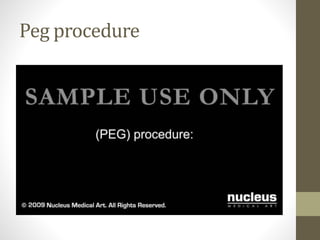 Peg procedure
 