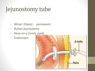 Jejunostomy tube
• Witzel (Open) - permanent
• Button jejunostomy
• Roue-en-y (rarely used)
• Endoscopic
 