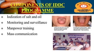 COMPONENTS OF IDDC
PROGRAMME
 Iodization of salt and oil
 Monitoring and surveillance
 Manpower training
 Mass communication
 