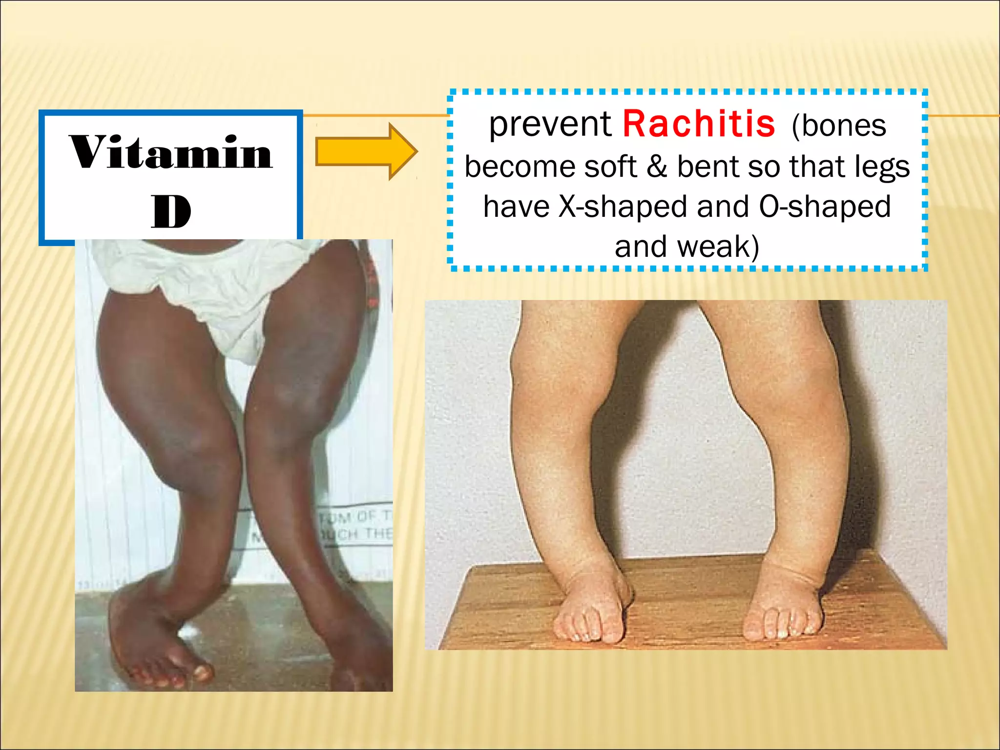 Vitamin
D
prevent Rachitis (bones
become soft & bent so that legs
have X-shaped and O-shaped
and weak)