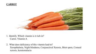 CARROT
1. Identify. Which vitamin is it rich in?
Carrot. Vitamin A
2. What does deficiency of this vitamin lead to?
Xeropthalmia, Night blindness, Conjunctival Xerosis, Bitot spots, Corneal
xerosis, keratomalacia
 