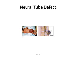 Neural Tube Defect
N.M.W
 