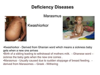 Kwashiorkor
Marasmus
Deficiency Diseases
•Kwashiorkor - Derived from Ghanian word which means a sickness baby
gets when a new one arrives
•Birth of a sibling leading to withdrawal of mothers milk. - Ghanese word –
sicknss the baby gets when the new one comes .
•Marasmus - Usually caused due to sudden stoppage of breast feeding. -
derived from Marasomes – Greek - Withering
 