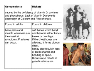 Osteomalacia Rickets
caused by the deficiency of vitamin D, calcium
and phosphorus. Lack of vitamin D prevents
absorption of Calcium and Phosphorous.
Found in adults Found in children
bone pains and
muscle weakness are
the classical
symptoms. Fractures
can occur.
soft bones which bend
and become either knock
knees or bow legs.
If the chest bones are
affected, it forms pigeon
chest.
It may also result in loss
of teeth enamel and
bending of spine.
Rickets also results in
growth retardation.
 
