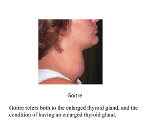 Goitre
Goitre refers both to the enlarged thyroid gland, and the
condition of having an enlarged thyroid gland.
 