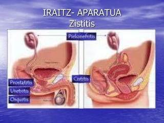 IRAITZ- APARATUA
Zistitis
 