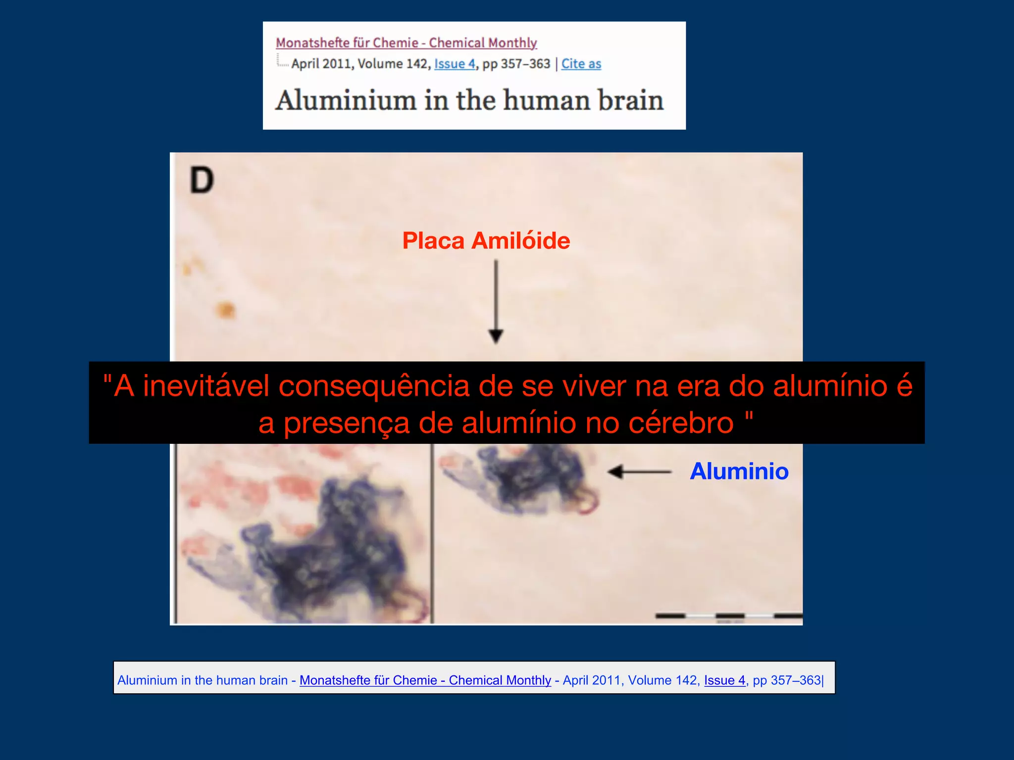Aluminium in the human brain - Monatshefte für Chemie - Chemical Monthly - April 2011, Volume 142, Issue 4, pp 357–363|
Aluminio
Placa Amilóide
"A inevitável consequência de se viver na era do alumínio é
a presença de alumínio no cérebro "
 