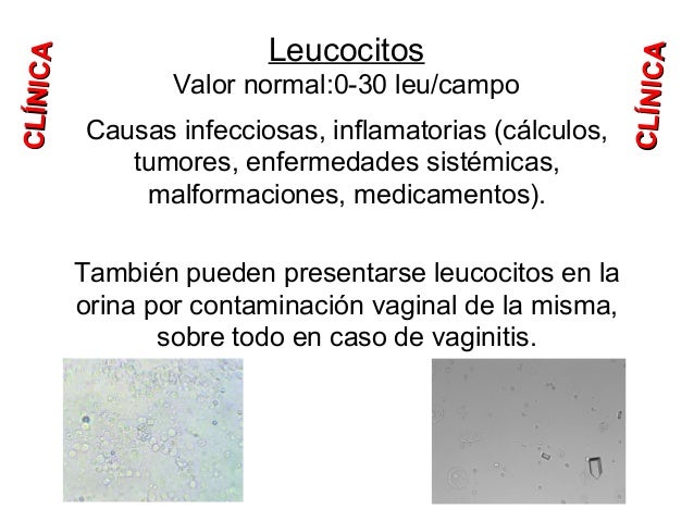 Interpretacion De Sedimento Urinario