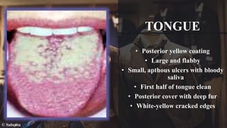 TONGUE
• Posterior yellow coating
• Large and flabby
• Small, apthous ulcers with bloody
saliva
• First half of tongue clean
• Posterior cover with deep fur
• White-yellow cracked edges
© Subrata
 