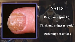NAILS
Dry, harsh (psoric).
+
Thick and ridges (sycotic)
Twitching sensations
© Subrata
 