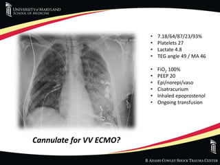 ECMO | PPTX