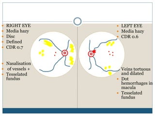  RIGHT EYE
 Media hazy
 Disc
 Defined
 CDR 0.7
 Nasalisation
 of vessels +
 Tesselated
fundus
 LEFT EYE
 Media hazy
 CDR 0.6
 Veins tortuous
and dilated
 Dot
hemorrhages in
macula
 Tesselated
fundus
 