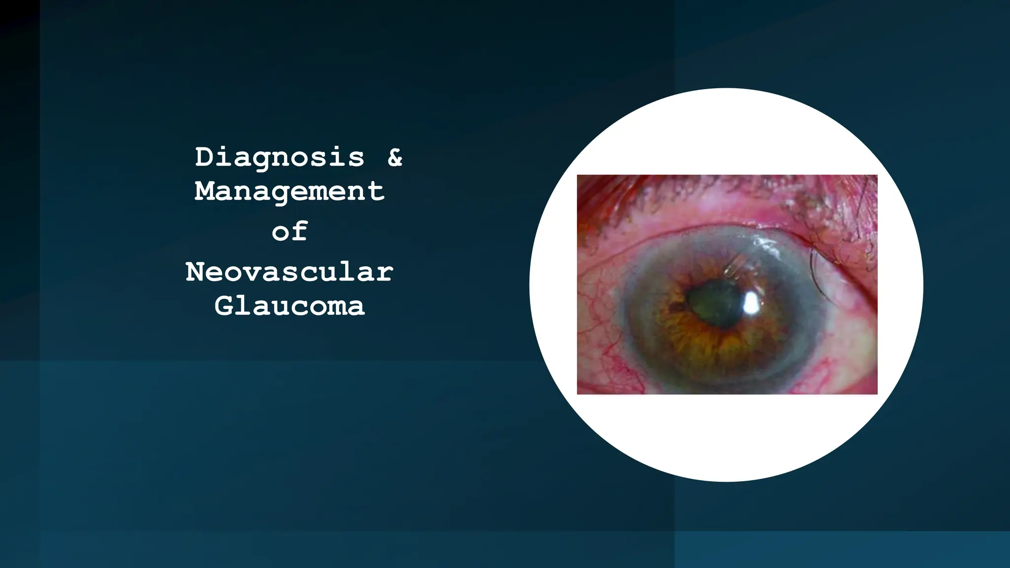 Diagnosis &
Management
of
Neovascular
Glaucoma
 