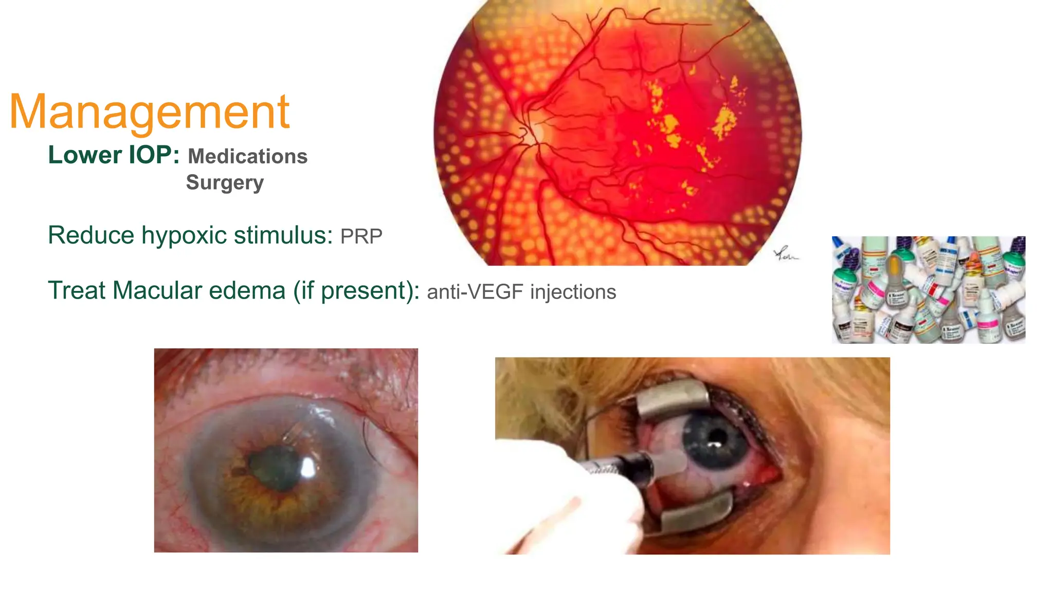 Management
Lower IOP: Medications
Surgery
Reduce hypoxic stimulus: PRP
Treat Macular edema (if present): anti-VEGF injections
 
