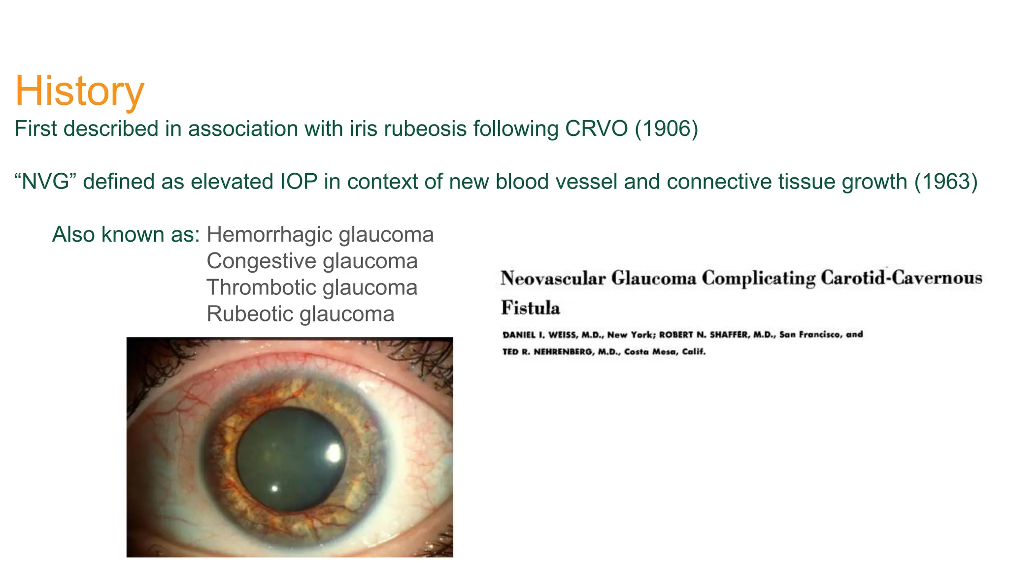 History
First described in association with iris rubeosis following CRVO (1906)
“NVG” defined as elevated IOP in context of new blood vessel and connective tissue growth (1963)
Also known as: Hemorrhagic glaucoma
Congestive glaucoma
Thrombotic glaucoma
Rubeotic glaucoma
 