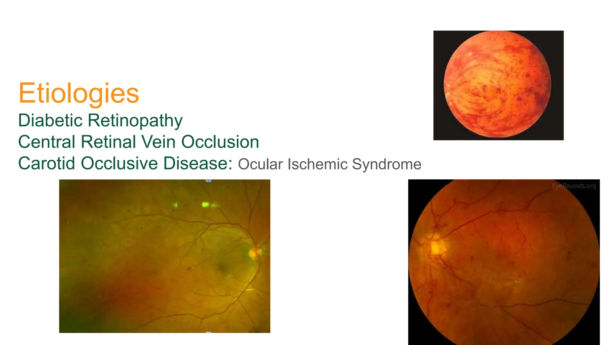Etiologies
Diabetic Retinopathy
Central Retinal Vein Occlusion
Carotid Occlusive Disease: Ocular Ischemic Syndrome
 