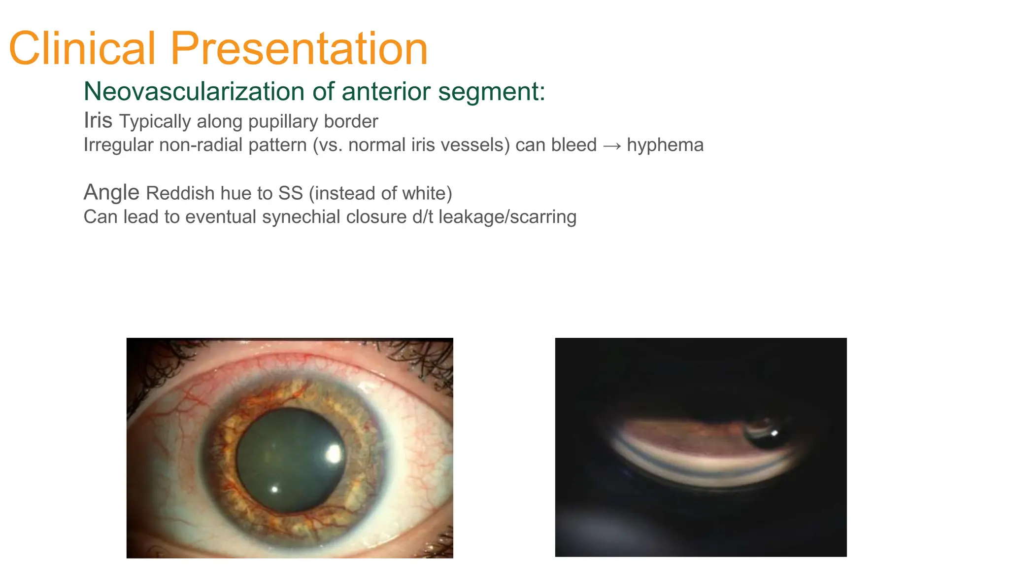 Clinical Presentation
Neovascularization of anterior segment:
Iris Typically along pupillary border
Irregular non-radial pattern (vs. normal iris vessels) can bleed → hyphema
Angle Reddish hue to SS (instead of white)
Can lead to eventual synechial closure d/t leakage/scarring
 