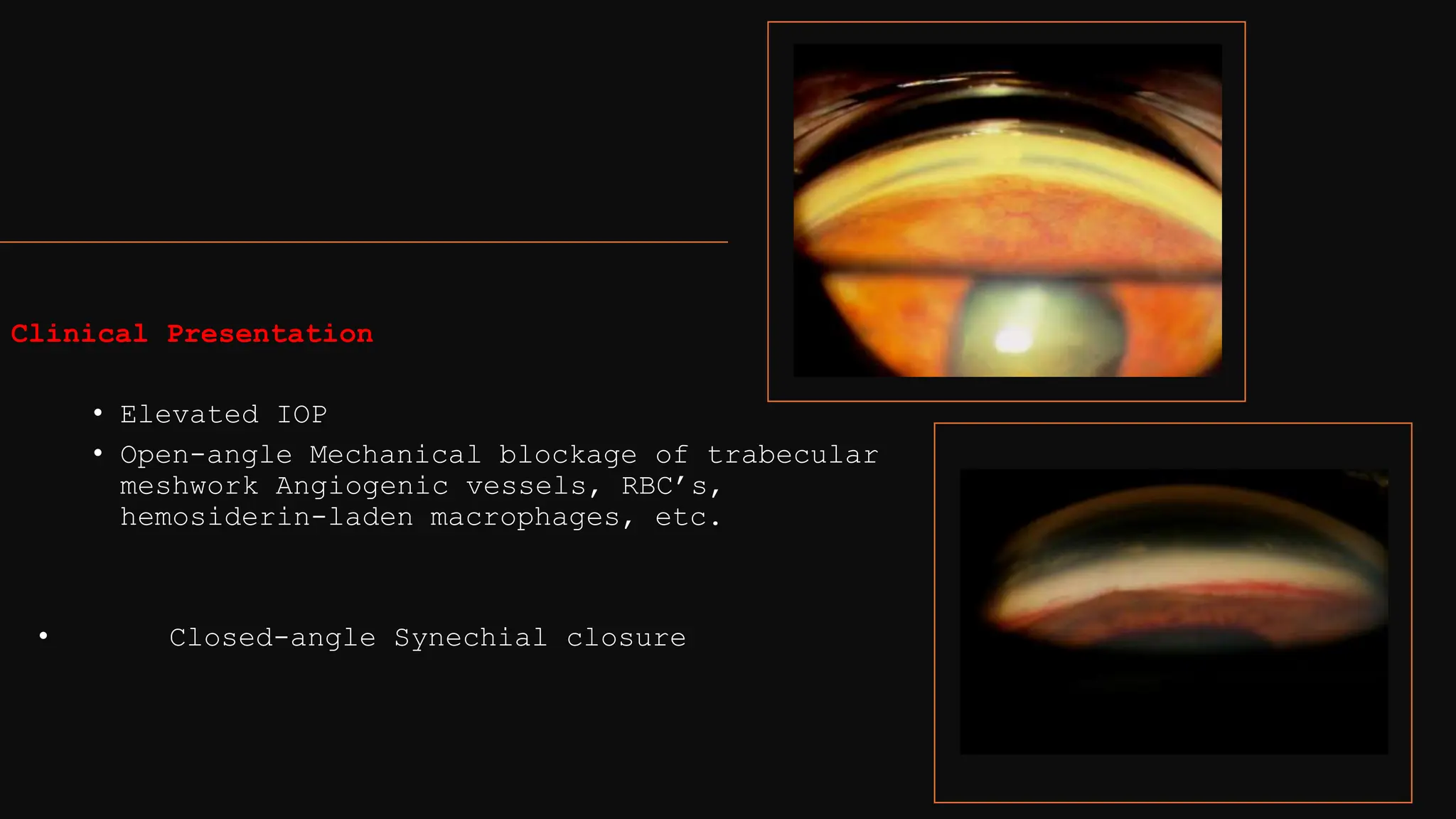 Clinical Presentation
• Elevated IOP
• Open-angle Mechanical blockage of trabecular
meshwork Angiogenic vessels, RBC’s,
hemosiderin-laden macrophages, etc.
• Closed-angle Synechial closure
 