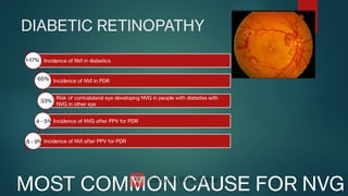 DIABETIC RETINOPATHY
MOST COMMON CAUSE FOR NVG
MOST COMMON CAUSE FOR NVG
Incidence of NVI in diabetics
Incidence of NVI in PDR
Risk of contralateral eye developing NVG in people with diabetes with
NVG in other eye
Incidence of NVG after PPV for PDR
Incidence of NVI after PPV for PDR
1-17%
65%
33%
4 - 5%
8 - 9%
 