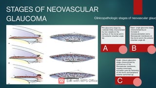 STAGES OF NEOVASCULAR
GLAUCOMA
•Pre-glaucoma stage (i.e.,
rubeosis iridis), characterized
by new vessels on the
surface of the iris (a) and in
the anterior chamber angle
(b).
A
•Open- angle glaucoma stage,
characterized by an
increase in
neovascularization and a
brovascular membrane on
the iris (c) and in the anterior
chamber angle (d).
B
•Angle- closure glaucoma
stage, characterized by
contracture of the
brovascular membrane,
causing corectopia,
ectropion uvea (e), attening
of the iris (f), and peripheral
anterior synechiae (g).
C
Clinicopathologic stages of neovascular glauc
 
