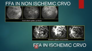 FFA IN ISCHEMIC CRVO
FFA IN ISCHEMIC CRVO
FFA IN NON ISCHEMIC CRVO
FFA IN NON ISCHEMIC CRVO
 
