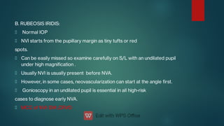 B. RUBEOSIS IRIDIS:
Normal IOP
NVI starts from the pupillary margin as tiny tufts or red
spots.
Can be easily missed so examine carefully on S/L with an undilated pupil
under high magnication .
Usually NVI is usually present before NVA.
However, in some cases, neovascularization can start at the angle rst.
Gonioscopy in an undilated pupil is essential in all high-risk
cases to diagnose early NVA.
MCC of NVI: DM ,CRVO
 