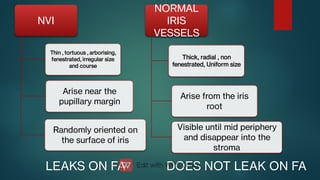 NVI
Thin , tortuous , arborising,
fenestrated, irregular size
and course
Randomly oriented on
the surface of iris
Arise near the
pupillary margin
NORMAL
IRIS
VESSELS
Thick, radial , non
fenestrated, Uniform size
Arise from the iris
root
Visible until mid periphery
and disappear into the
stroma
LEAKS ON FA
LEAKS ON FA DOES NOT LEAK ON FA
DOES NOT LEAK ON FA
 