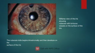 Slitlamp view of the iris
showing
rubeosis with tortuous
vessels on the surface of the
iris.
The rubeosis iridis begins intrastromally and then develops on
the
surface of the iris
 