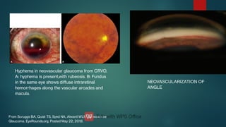 Hyphema in neovascular glaucoma from CRVO.
A: hyphema is present,with rubeosis. B: Fundus
in the same eye shows diﬀuse intraretinal
hemorrhages along the vascular arcades and
macula.
From Scruggs BA, Quist TS, Syed NA, Alward WLM. Neovascular
Glaucoma. EyeRounds.org. Posted May 22, 2018.
NEOVASCULARIZATION OF
ANGLE
 