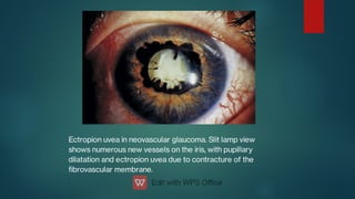 Ectropion uvea in neovascular glaucoma. Slit lamp view
shows numerous new vessels on the iris, with pupillary
dilatation and ectropion uvea due to contracture of the
brovascular membrane.
 
