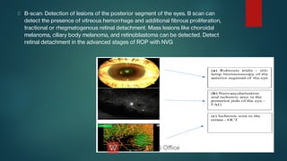 B-scan: Detection of lesions of the posterior segment of the eyes. B scan can
detect the presence of vitreous hemorrhage and additional brous proliferation,
tractional or rhegmatogenous retinal detachment. Mass lesions like choroidal
melanoma, ciliary body melanoma, and retinoblastoma can be detected. Detect
retinal detachment in the advanced stages of ROP with NVG
 