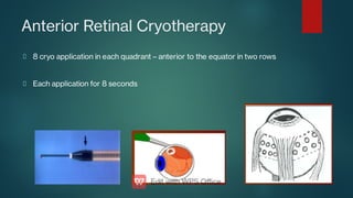 Anterior Retinal Cryotherapy
8 cryo application in each quadrant – anterior to the equator in two rows
Each application for 8 seconds
 