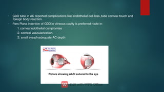 -
-
GDD tube in AC reported complications like endothelial cell loss ,tube corneal touch and
foreign body reaction.
Pars Plana insertion of GDD in vitreous cavity is preferred route in:
1. corneal edothelial compromise
2. corneal vascularization.
3. small eyes/inadequate AC depth
 