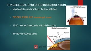 



TRANSCLERAL CYCLOPHOTOCOAGULATION:
Most widely used method of ciliary ablation
DIODE LASER: 810 wavelength used
1250 mW for 3 seconds with 18-24 spots
40-80% success rates
 