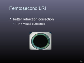 Femtosecond LRI
 better refraction correction
 --> + visual outcomes

105

 