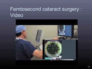Femtosecond cataract surgery :
Video

107

 
