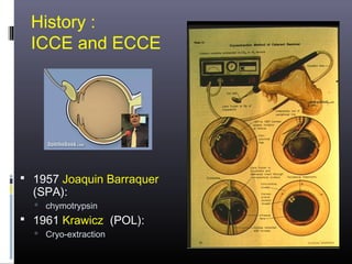 History :
ICCE and ECCE

 1957 Joaquin Barraquer

(SPA):


chymotrypsin

 1961 Krawicz (POL):


Cryo-extraction

 