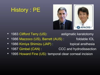 History : PE

 1983 Clifford Terry (US):
astigmatic keratotomy
 1986 Mazzoco (US), Barrett (AUS) :
foldable IOL
 1986 Kimiya Shimizu (JAP) :
topical ansthesia
 1987 Gimbel (CAN) :
CCC and hydrodissection
 1995 Howard Fine (US): temporal clear corneal incision

 