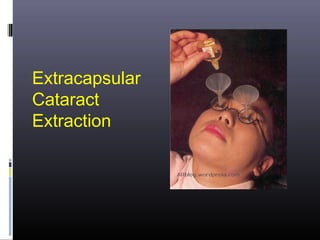 Extracapsular
Cataract
Extraction

 