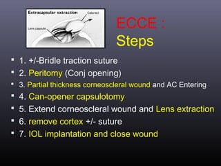 ECCE :
Steps
 1. +/-Bridle traction suture
 2. Peritomy (Conj opening)
 3. Partial thickness corneoscleral wound and AC Entering

 4. Can-opener capsulotomy
 5. Extend corneoscleral wound and Lens extraction
 6. remove cortex +/- suture
 7. IOL implantation and close wound

 