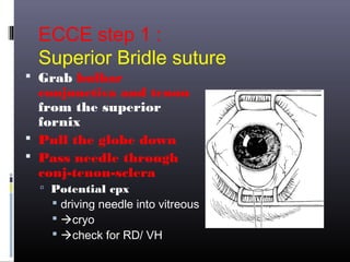 ECCE step 1 :
Superior Bridle suture
 Grab bulbar

conjunctiva and tenon
from the superior
fornix
 Pull the globe down
 Pass needle through
conj-tenon-sclera
 Potential cpx

 driving needle into vitreous
 cryo
 check for RD/ VH

 