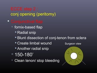 ECCE step 2 :
conj opening (peritomy)
 Conjunctival flap
 fornix-based flap

 Radial snip
 Blunt dissection of conj-tenon from sclera
 Create limbal wound
Surgeon view
 Another radial snip

 150-180’
 Clean tenon/ stop bleeding

 