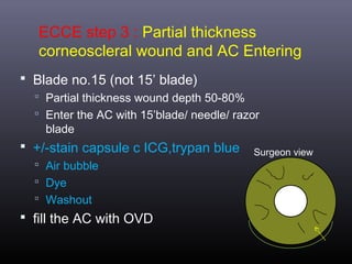ECCE step 3 : Partial thickness
corneoscleral wound and AC Entering
 Blade no.15 (not 15’ blade)
 Partial thickness wound depth 50-80%
 Enter the AC with 15’blade/ needle/ razor

blade

 +/-stain capsule c ICG,trypan blue
 Air bubble
 Dye
 Washout

 fill the AC with OVD

Surgeon view

 