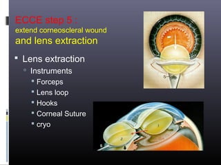 ECCE step 5 :

extend corneoscleral wound

and lens extraction
 Lens extraction
 Instruments
 Forceps

 Lens loop
 Hooks
 Corneal Suture
 cryo

 