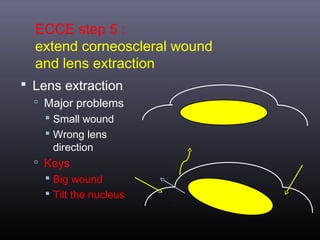 ECCE step 5 :
extend corneoscleral wound
and lens extraction
 Lens extraction
 Major problems
 Small wound

 Wrong lens
direction
 Keys
 Big wound

 Tilt the nucleus

 