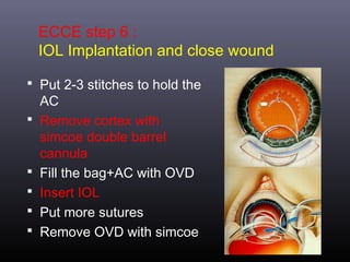 ECCE step 6 :
IOL Implantation and close wound
 Put 2-3 stitches to hold the







AC
Remove cortex with
simcoe double barrel
cannula
Fill the bag+AC with OVD
Insert IOL
Put more sutures
Remove OVD with simcoe

 