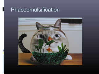 Phacoemulsification

 