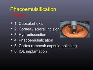 Phacoemulsification
: Steps
 1. Capsulorhexis
 2. Corneal/ scleral incision
 3. Hydrodissection
 4. Phacoemulsification
 5. Cortex removal/ capsule polishing
 6. IOL implantation

 