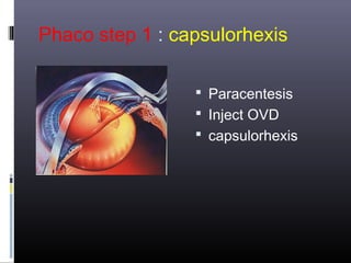 Phaco step 1 : capsulorhexis
 Paracentesis
 Inject OVD
 capsulorhexis

 